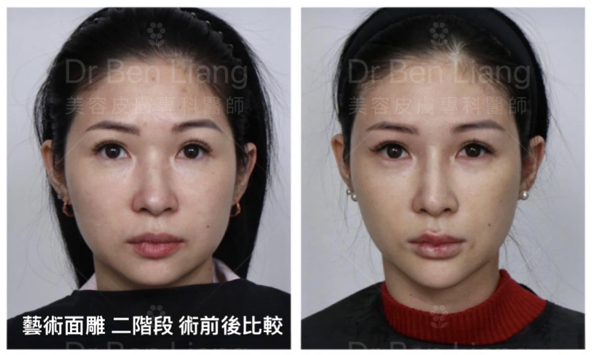 藝術面雕 Plus 二階段術前後比較